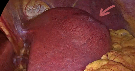 Caso Clínico Destacado: Tratamiento Exitoso de Tumor Neuroendocrino Primario de Hígado